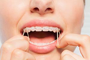 dental bands braces