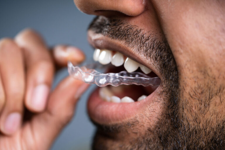 What Happens If I Stop Wearing My Retainer?